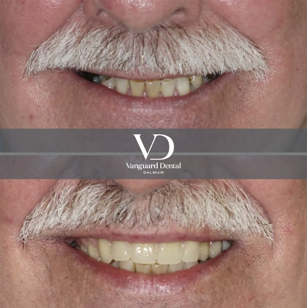 Before and after smile transformation, patient photo