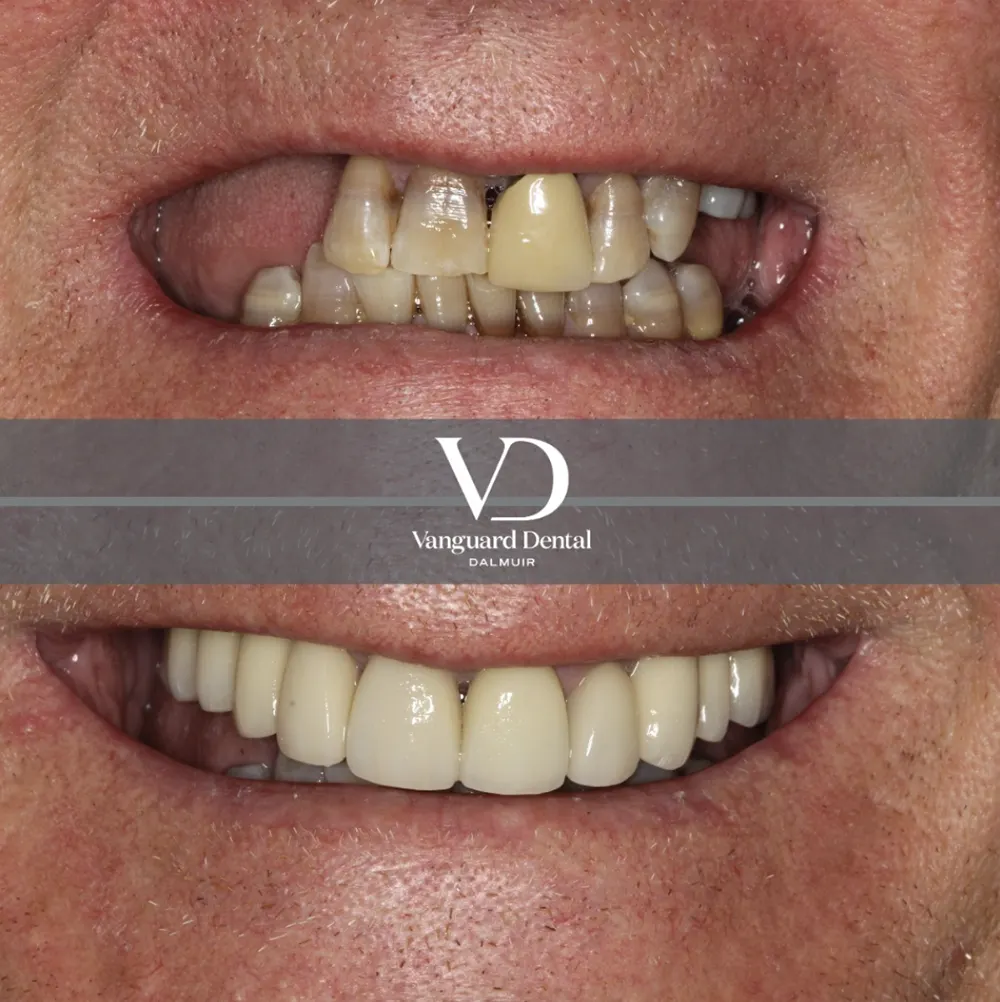 Before and after smile transformation, patient photo