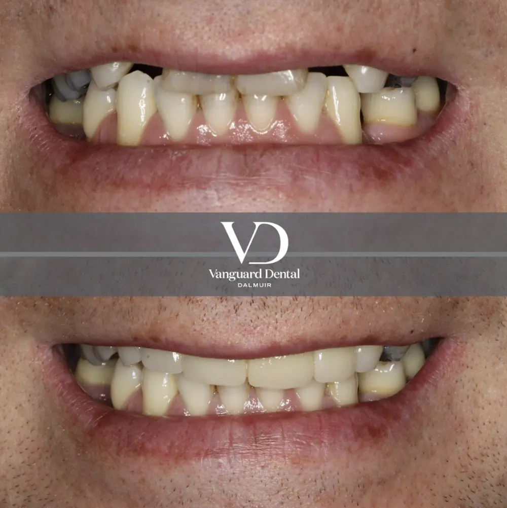 Before and after smile transformation, patient photo